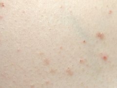 点滴状副牛皮癣的特点