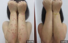 手臂寻常型银屑病的治疗