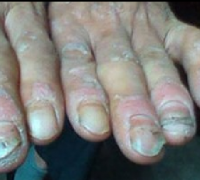 银屑病关节炎的临床症状有哪些？